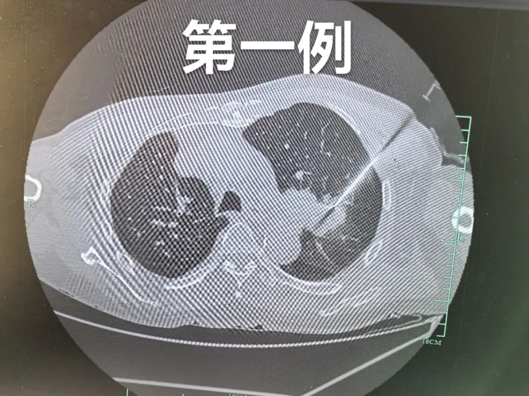 病理切片快递怎么包装【新闻快递】呼吸一科率先开展AI-ROSE人工智能现场快速病理诊断技术_https://www.jmylbn.com_新闻资讯_第2张