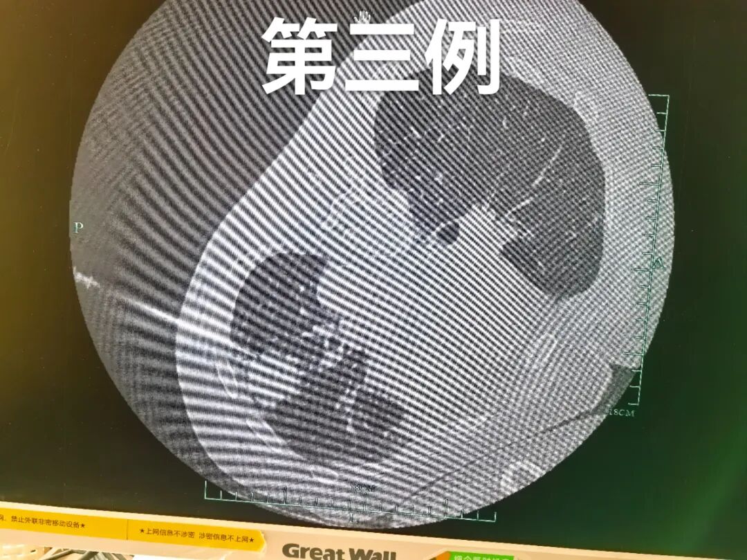 病理切片快递怎么包装【新闻快递】呼吸一科率先开展AI-ROSE人工智能现场快速病理诊断技术_https://www.jmylbn.com_新闻资讯_第4张