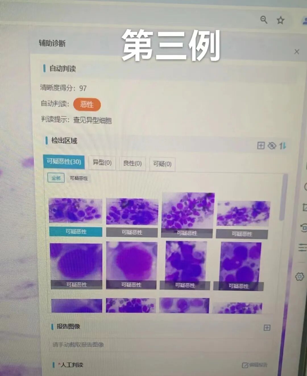 病理切片快递怎么包装【新闻快递】呼吸一科率先开展AI-ROSE人工智能现场快速病理诊断技术_https://www.jmylbn.com_新闻资讯_第7张