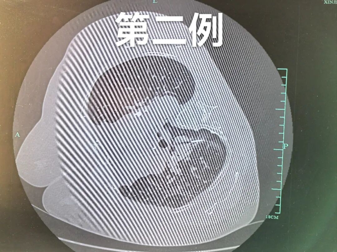 病理切片快递怎么包装【新闻快递】呼吸一科率先开展AI-ROSE人工智能现场快速病理诊断技术_https://www.jmylbn.com_新闻资讯_第3张