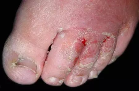 对于足指缝间,糜烂渗出,有很好的预防丹毒发生的功效!
