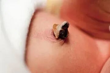 婴儿脐带夹怎么打开宝宝的脐带多久会脱落？脱落前该怎么护理？_https://www.jmylbn.com_新闻资讯_第3张