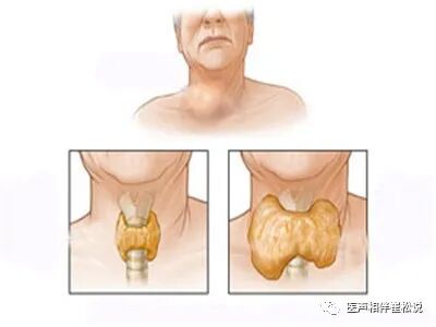 女性甲亢早期脖子两侧图片_甲亢突眼正常图片_甲亢脖子和正常脖子图片