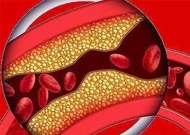 吃他汀两年低密度脂蛋白1.0以下，斑块会缩小吗？