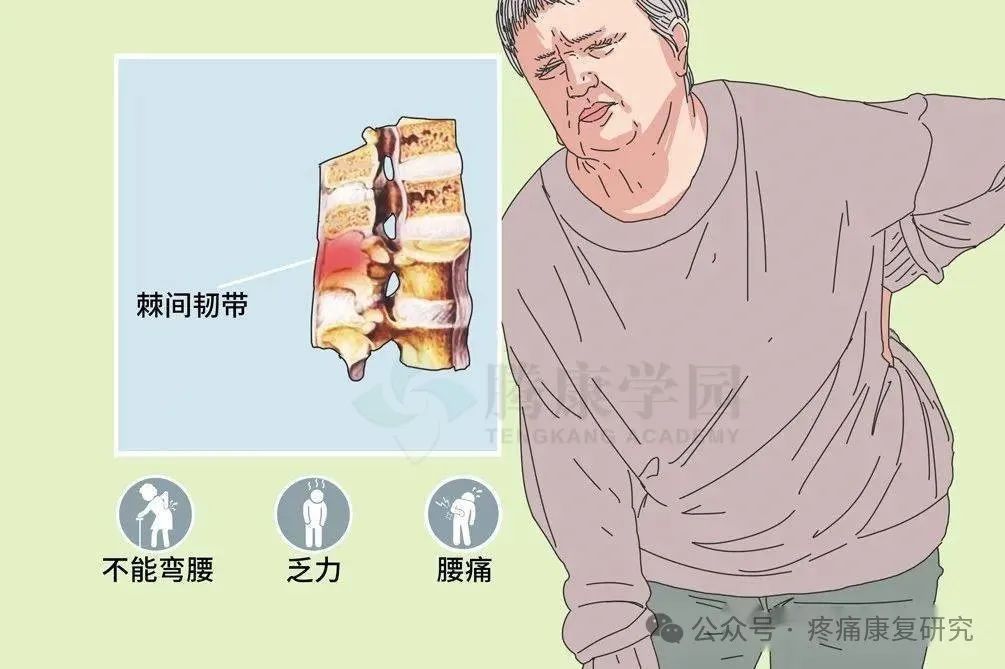 腰痛常见但易忽视的疾病：棘间韧带炎