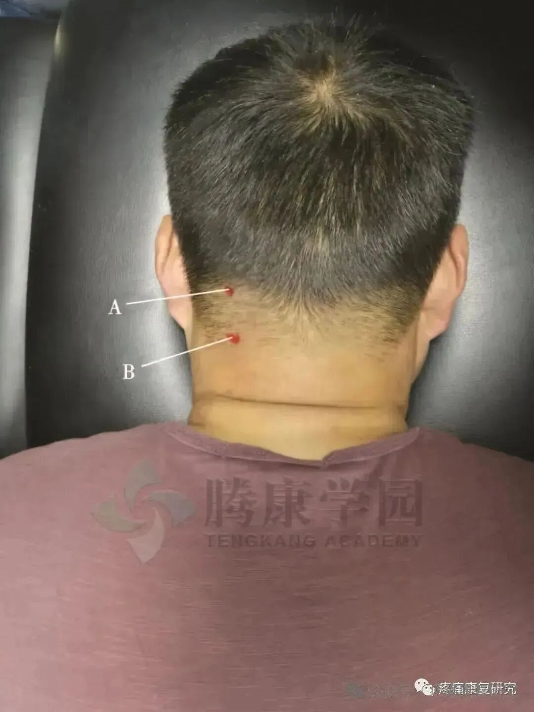 枕后4条神经：枕大、枕小、枕下及第三枕神经