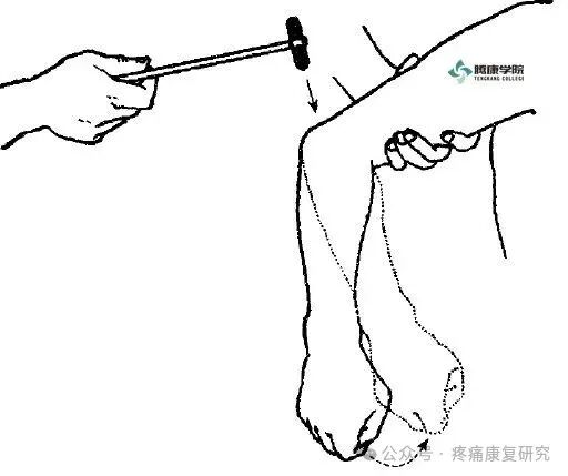叩诊锤的怎么用康复必备：41个常见的神经反射检查_https://www.jmylbn.com_新闻资讯_第16张