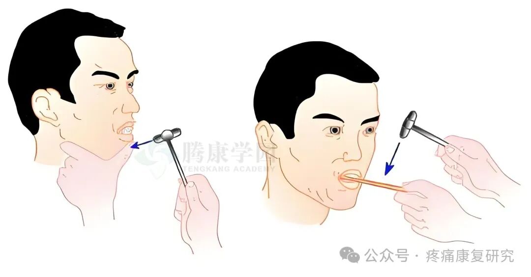 叩诊锤的怎么用康复必备：41个常见的神经反射检查_https://www.jmylbn.com_新闻资讯_第2张