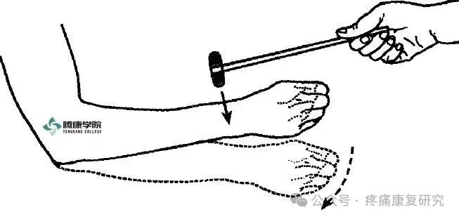 叩诊锤的怎么用康复必备：41个常见的神经反射检查_https://www.jmylbn.com_新闻资讯_第18张