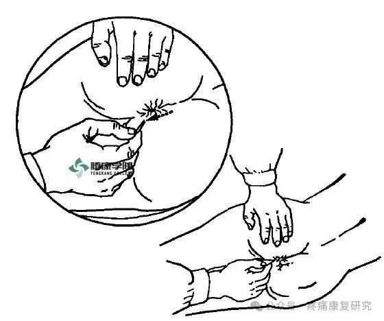 叩诊锤的怎么用康复必备：41个常见的神经反射检查_https://www.jmylbn.com_新闻资讯_第25张