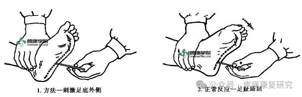 叩诊锤的怎么用康复必备：41个常见的神经反射检查_https://www.jmylbn.com_新闻资讯_第24张