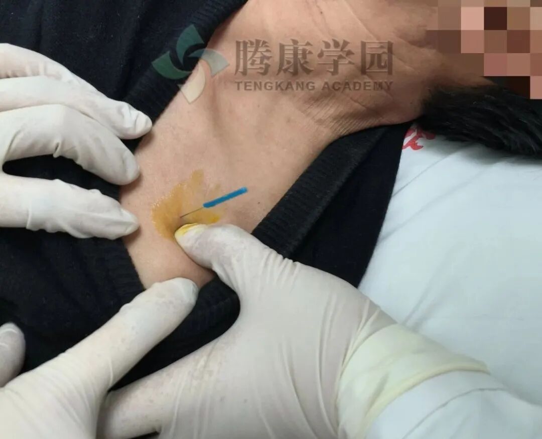 【神经反射疗法】肩痛的必治点