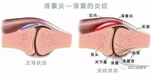 蹒跚步态诊断耻骨骨炎综合征 自由微信 Freewechat