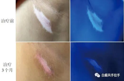 围白斑照射：难治性白癜风的有效选择