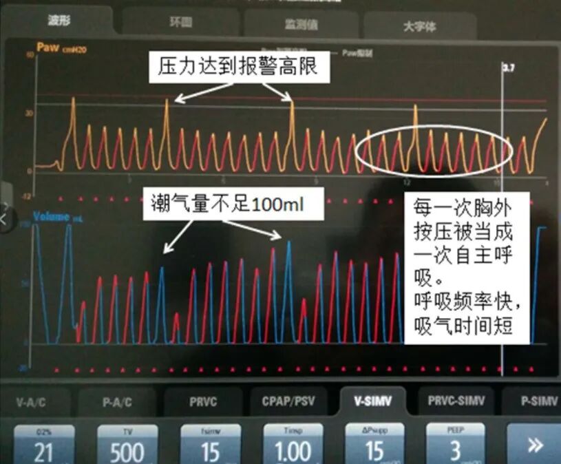 容控模式怎么表示全院都是呼吸科？那这个「呼吸基本功」你需要掌握_https://www.jmylbn.com_新闻资讯_第6张