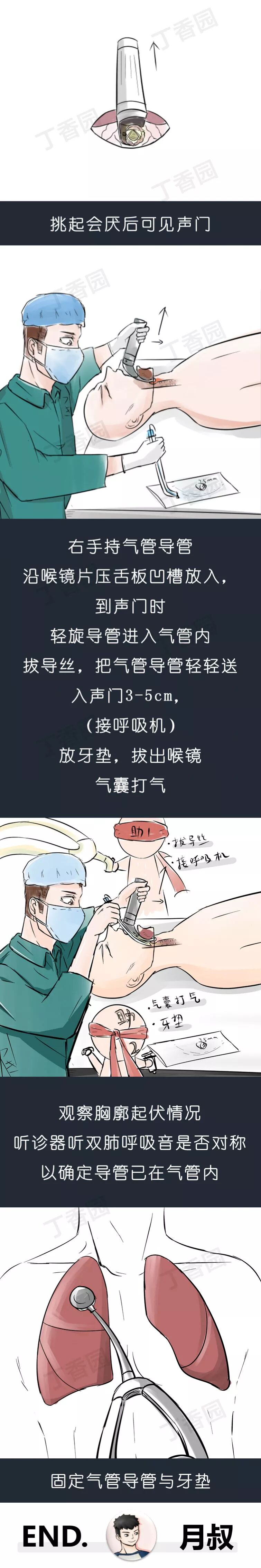 气管插管牙垫怎么放【急救】院前急救之经口气管插管术_https://www.jmylbn.com_新闻资讯_第19张