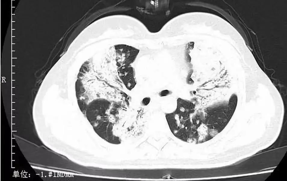 肺部感染 ct 怎麼看?_醫學界-助力醫生臨床決策和職業成長