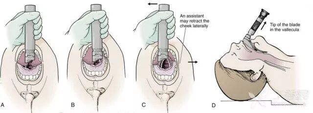 气管插管牙垫怎么放这是关于气管插管最全总结，欢迎转发_https://www.jmylbn.com_新闻资讯_第13张