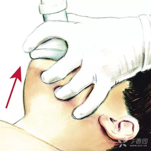 气管插管牙垫怎么放这是关于气管插管最全总结，欢迎转发_https://www.jmylbn.com_新闻资讯_第11张