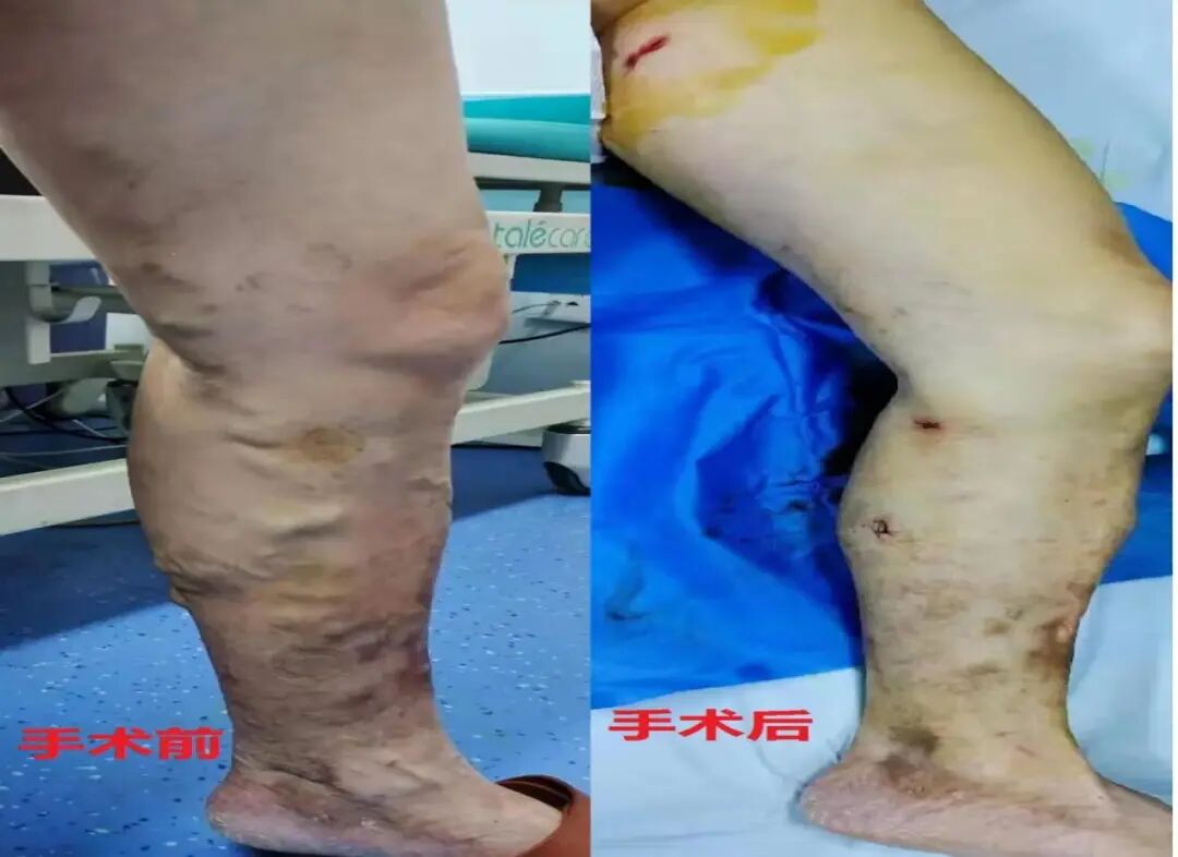 医用弹力袜用什么洗科普新知 ｜ 别误会，它只是看着很像丝袜......_https://www.jmylbn.com_新闻资讯_第13张