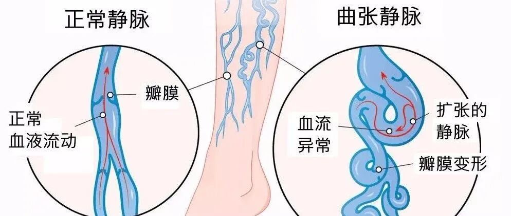 医用弹力袜用什么洗科普新知 ｜ 别误会，它只是看着很像丝袜......_https://www.jmylbn.com_新闻资讯_第11张