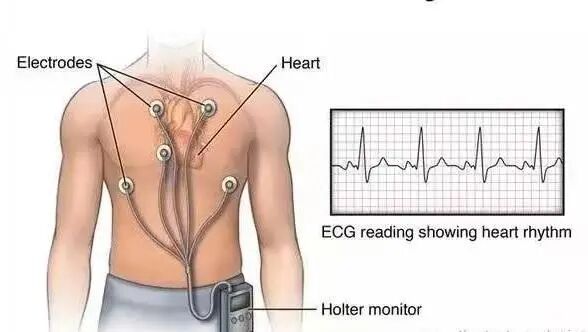 动态心电怎么拆科普新知 ｜ 心脏嘭嘭乱跳心电图却没问题？还得这么查_https://www.jmylbn.com_新闻资讯_第4张