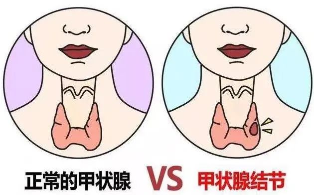 查出甲狀腺結節怎麼辦有這3種情況最好趕緊手術