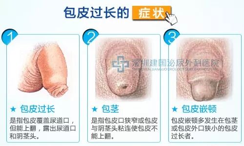 包皮有裂口 有一圈白色像皮筋勒着是的 包皮口有一圈很紧的白圈 二安网