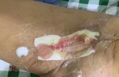 vsd引流器怎么连接如何自己制作负压引流装置？这里有一份图文教程送给你_https://www.jmylbn.com_新闻资讯_第7张