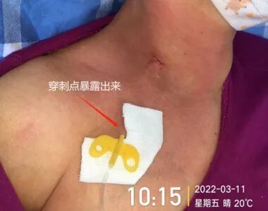 为什么输液要盖块纱布输液港穿刺点什么时候暴露？什么时候覆盖？看完这两个案例你就明白了_https://www.jmylbn.com_新闻资讯_第6张