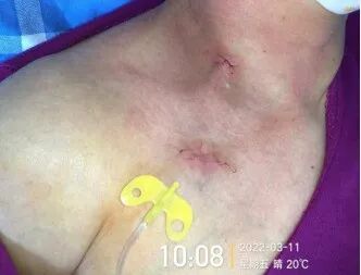 为什么输液要盖块纱布输液港穿刺点什么时候暴露？什么时候覆盖？看完这两个案例你就明白了_https://www.jmylbn.com_新闻资讯_第5张