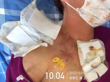 为什么输液要盖块纱布输液港穿刺点什么时候暴露？什么时候覆盖？看完这两个案例你就明白了_https://www.jmylbn.com_新闻资讯_第4张