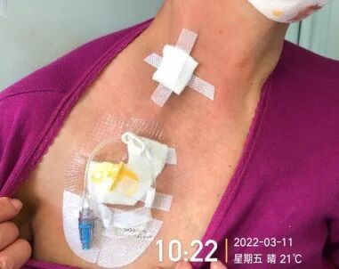 为什么输液要盖块纱布输液港穿刺点什么时候暴露？什么时候覆盖？看完这两个案例你就明白了_https://www.jmylbn.com_新闻资讯_第7张