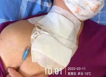 为什么输液要盖块纱布输液港穿刺点什么时候暴露？什么时候覆盖？看完这两个案例你就明白了_https://www.jmylbn.com_新闻资讯_第3张