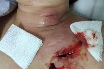 为什么输液要盖块纱布输液港穿刺点什么时候暴露？什么时候覆盖？看完这两个案例你就明白了_https://www.jmylbn.com_新闻资讯_第2张