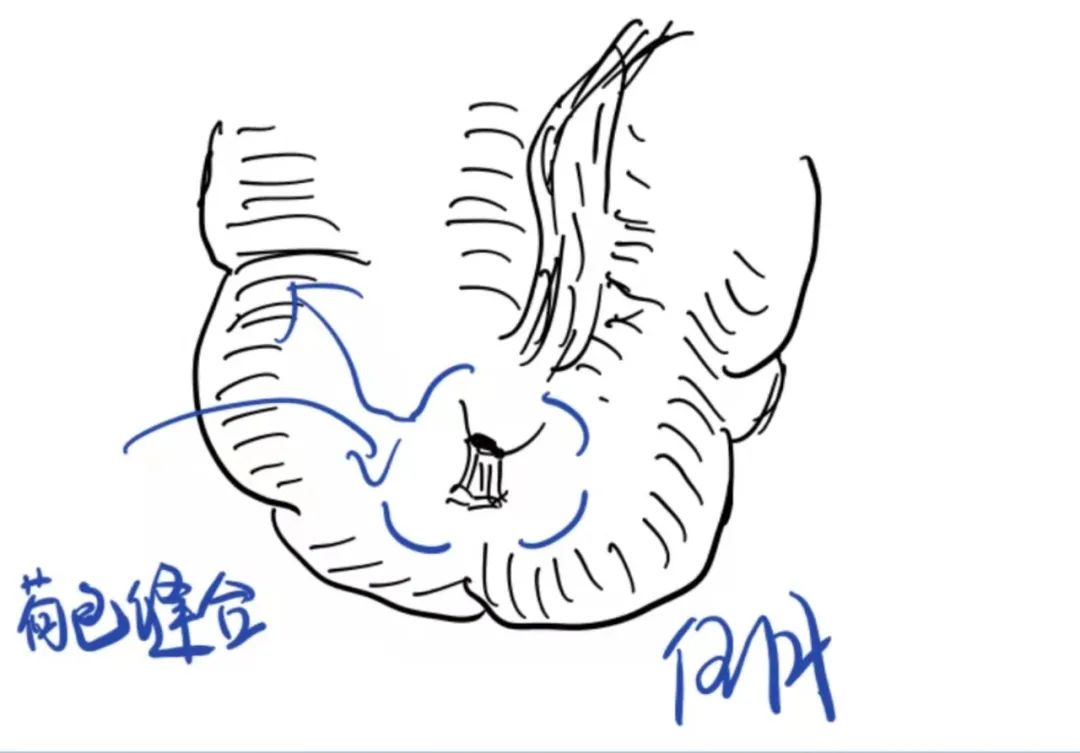 缝伤口怎么打结急诊外科必备技能——清创缝合术_https://www.jmylbn.com_新闻资讯_第11张