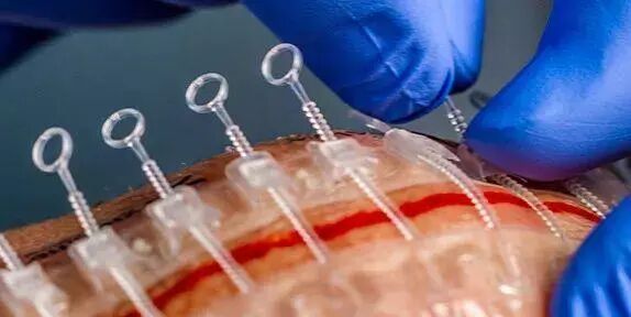 为什么用皮肤吻合器这 3 种「缝皮」方法，既不需针，也不用线_https://www.jmylbn.com_新闻资讯_第4张