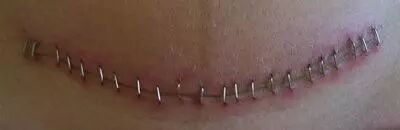 为什么用皮肤吻合器这 3 种「缝皮」方法，既不需针，也不用线_https://www.jmylbn.com_新闻资讯_第3张