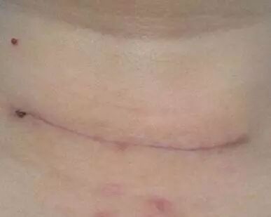 为什么用皮肤吻合器这 3 种「缝皮」方法，既不需针，也不用线_https://www.jmylbn.com_新闻资讯_第2张