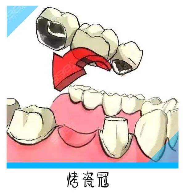 缺牙三年还能镶牙吗？镶牙大概需要多少钱？