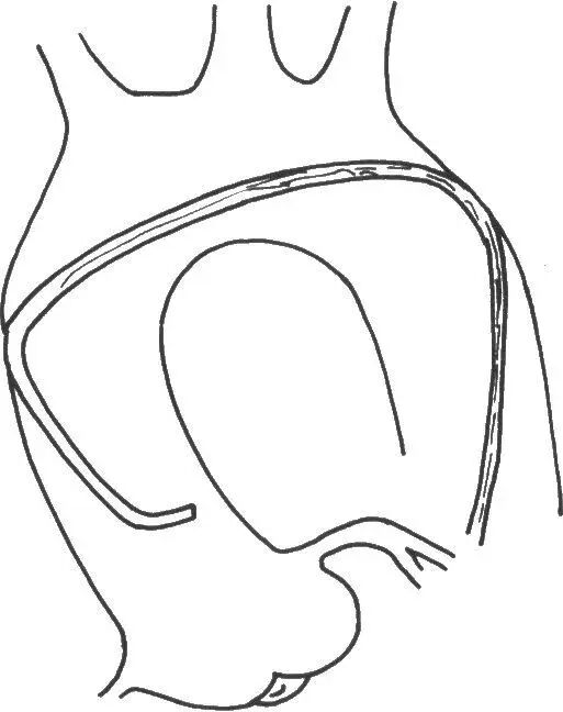 介入导管有哪些型号早读 ｜ 冠脉介入离不开的导管，你需要这篇文章！_https://www.jmylbn.com_新闻资讯_第14张