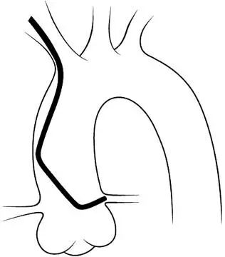 介入导管有哪些型号早读 ｜ 冠脉介入离不开的导管，你需要这篇文章！_https://www.jmylbn.com_新闻资讯_第7张