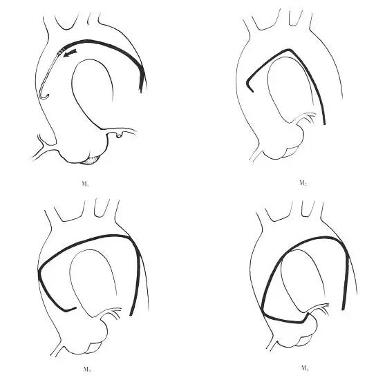 介入导管有哪些型号早读 ｜ 冠脉介入离不开的导管，你需要这篇文章！_https://www.jmylbn.com_新闻资讯_第6张