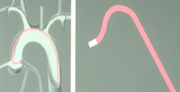 介入导管有哪些型号早读 ｜ 冠脉介入离不开的导管，你需要这篇文章！_https://www.jmylbn.com_新闻资讯_第21张