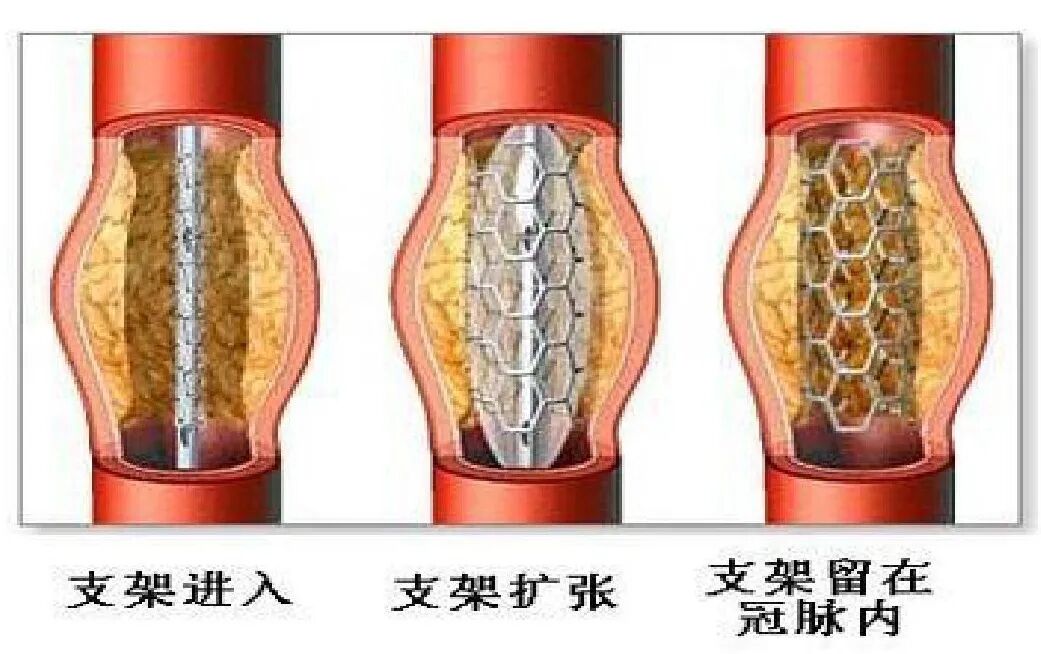 介入导管有哪些型号早读 ｜ 冠脉介入离不开的导管，你需要这篇文章！_https://www.jmylbn.com_新闻资讯_第2张