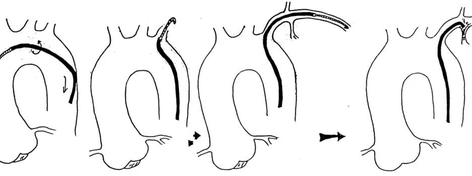介入导管有哪些型号早读 ｜ 冠脉介入离不开的导管，你需要这篇文章！_https://www.jmylbn.com_新闻资讯_第19张