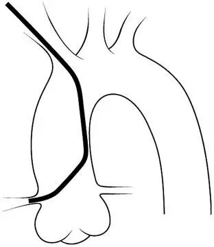 介入导管有哪些型号早读 ｜ 冠脉介入离不开的导管，你需要这篇文章！_https://www.jmylbn.com_新闻资讯_第8张