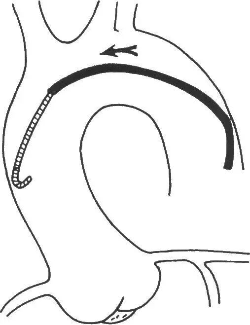 介入导管有哪些型号早读 ｜ 冠脉介入离不开的导管，你需要这篇文章！_https://www.jmylbn.com_新闻资讯_第13张