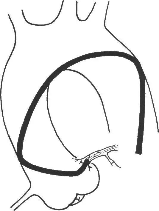 介入导管有哪些型号早读 ｜ 冠脉介入离不开的导管，你需要这篇文章！_https://www.jmylbn.com_新闻资讯_第15张