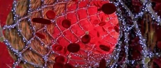 早读 | 支架内为什么会形成血栓？作者翻遍了各大研究